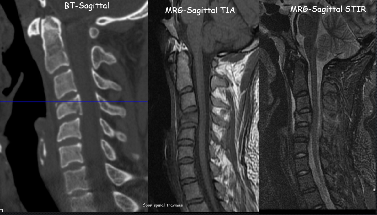 Spinal Travmalar Radyolojisi